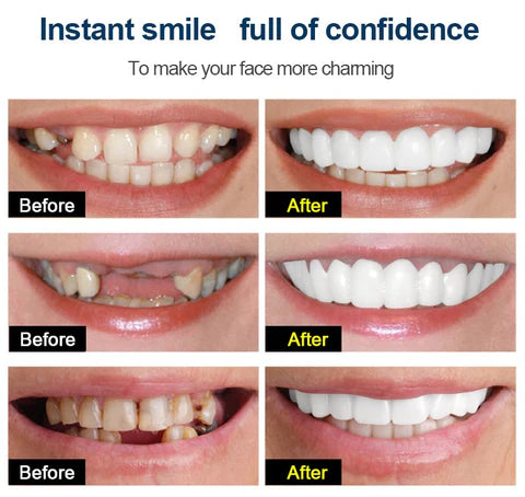 Snap on Smile teeth Cover